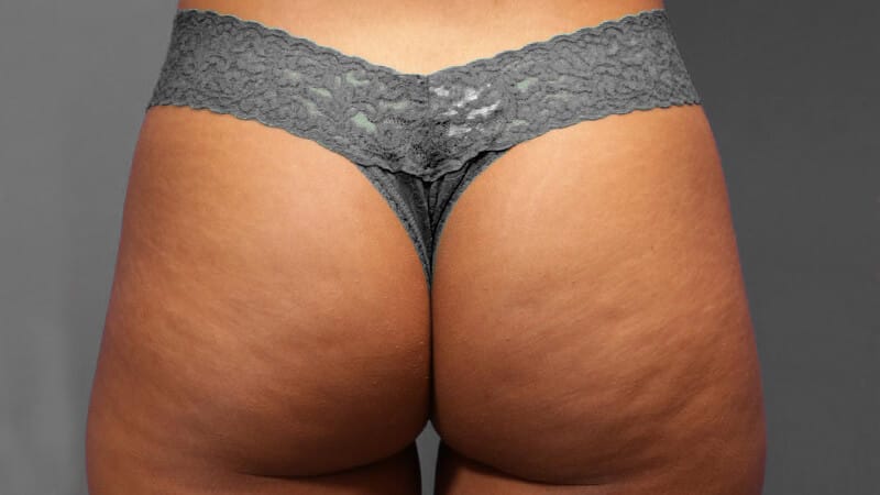 Cellulite verwijderen vooraf aan de endermologie behandeling