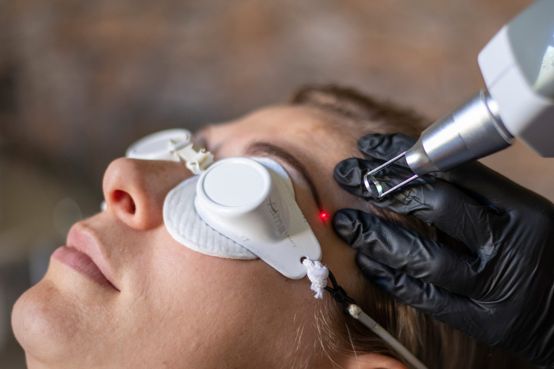 Verwijderen van permanente make-up met behulp van een laserbehandeling